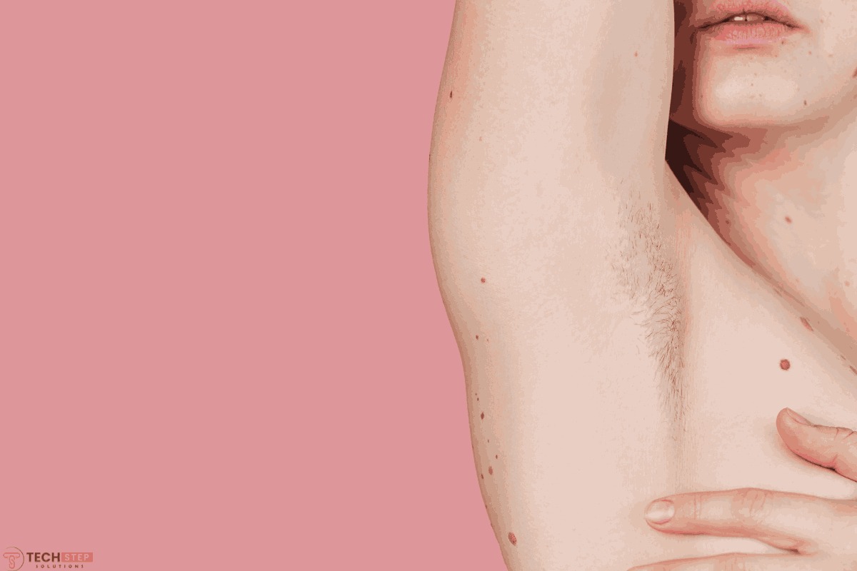 Underarm hyperpigmentation