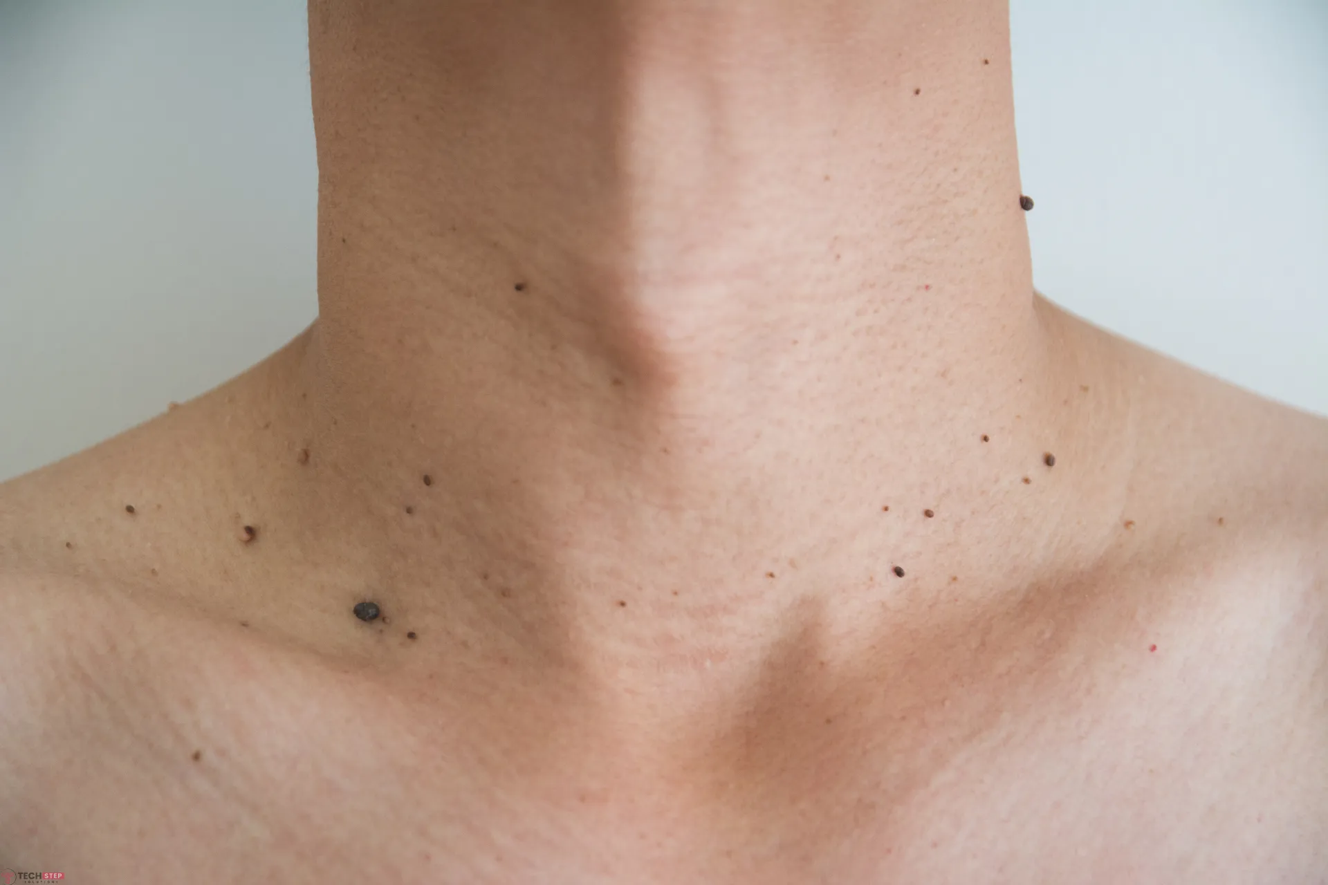 Are Skin Tags Contagious
