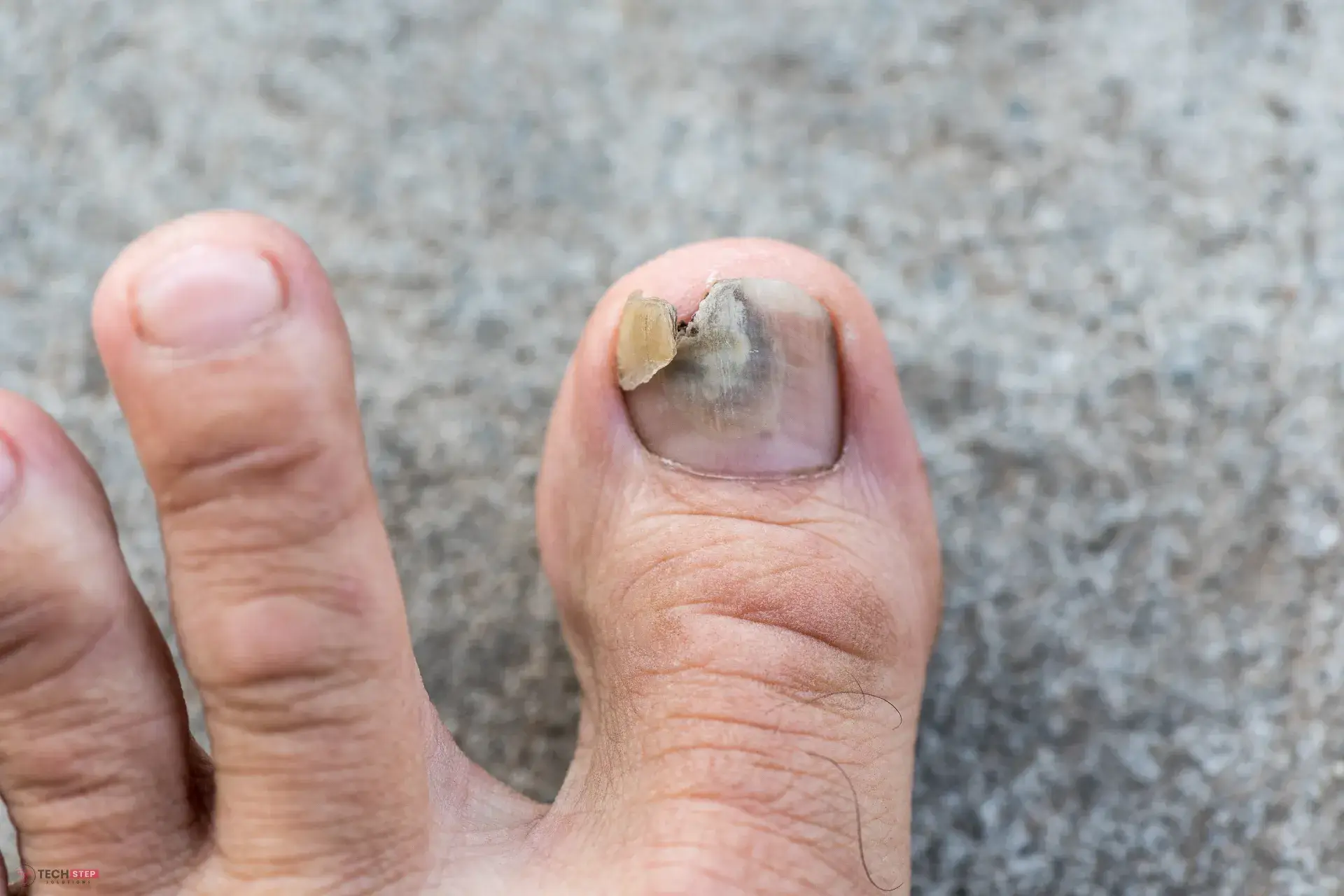 Best Treatment for Fungus Toenails