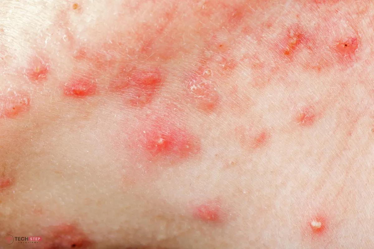 Acne Explained Root Causes and Factors That Lead to Breakouts