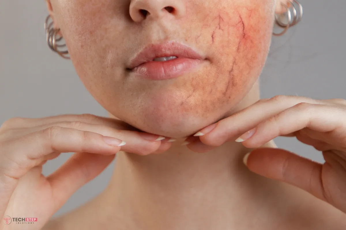 Rosacea Treatment Houston TX