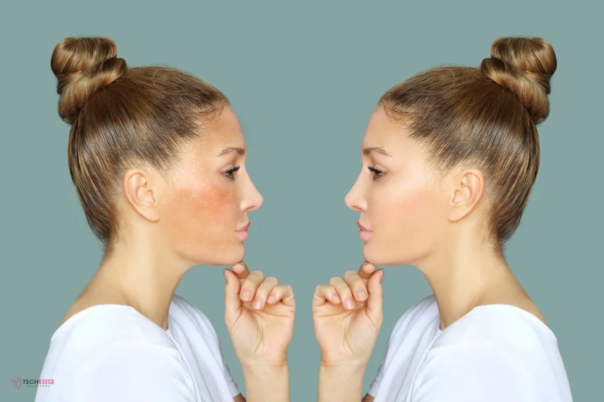 Benefits of Targeted Melasma Therapy at Yana Skin Care