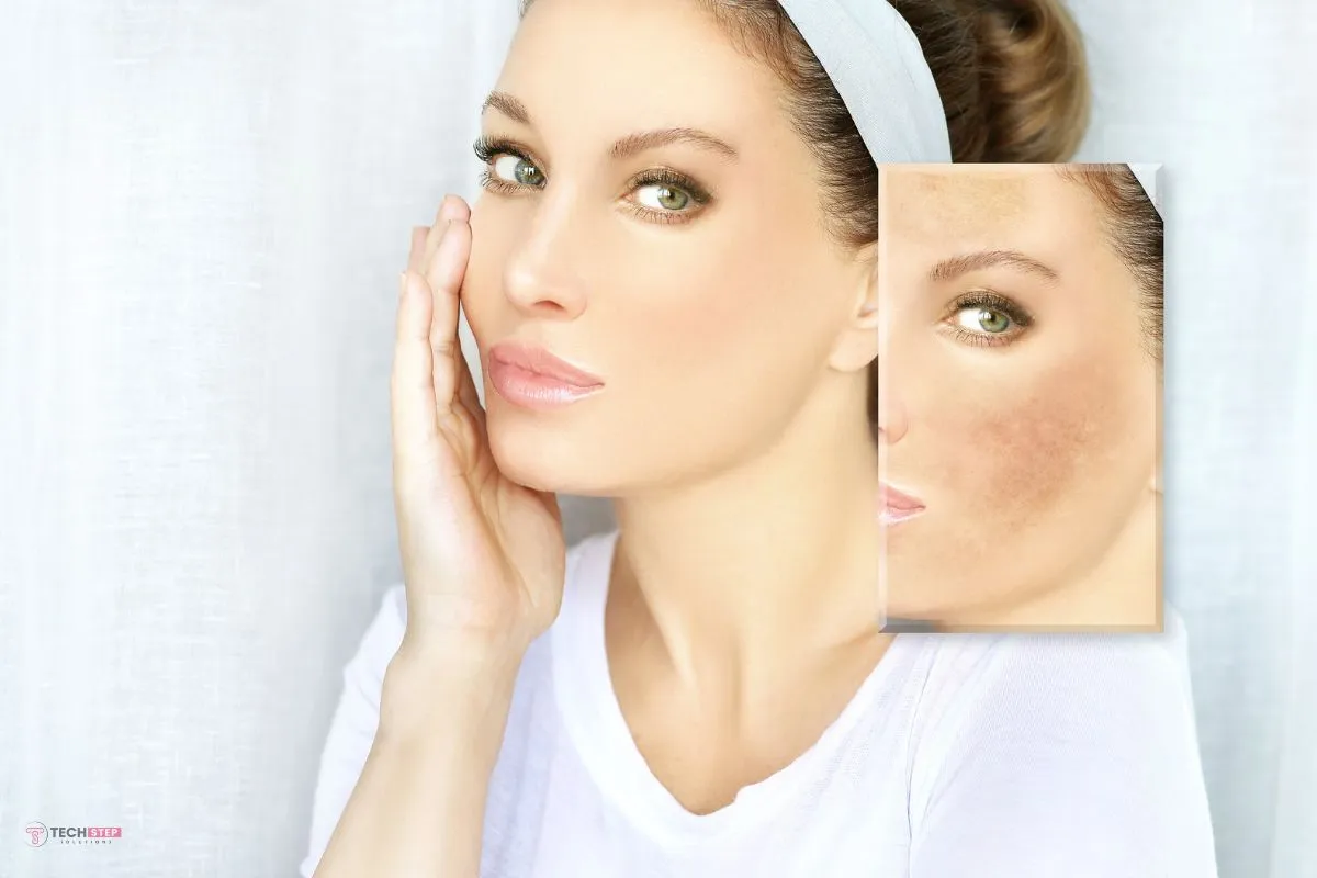 Best Candidates for Melasma Treatment