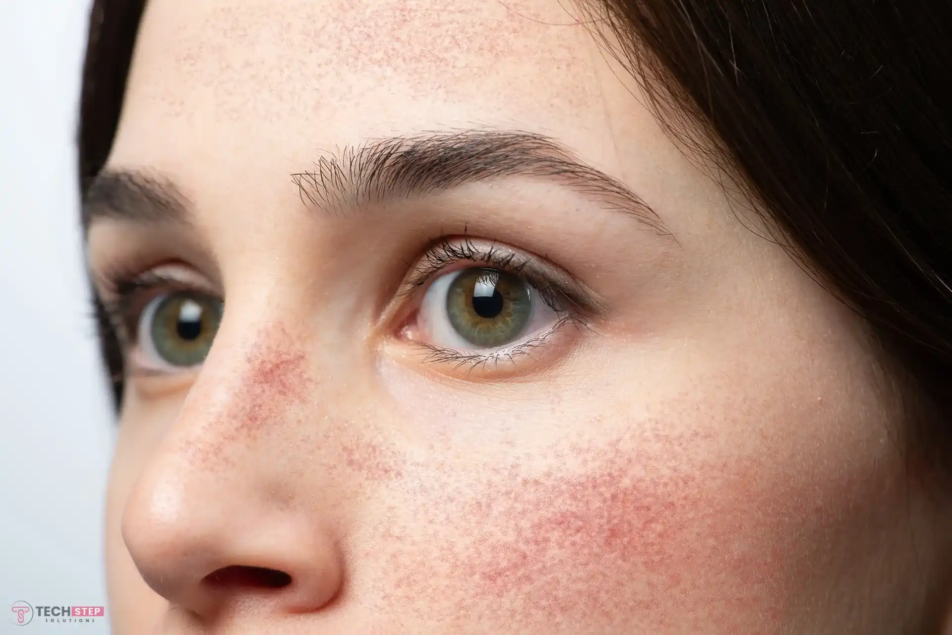 Rosacea Treatment Houston TX