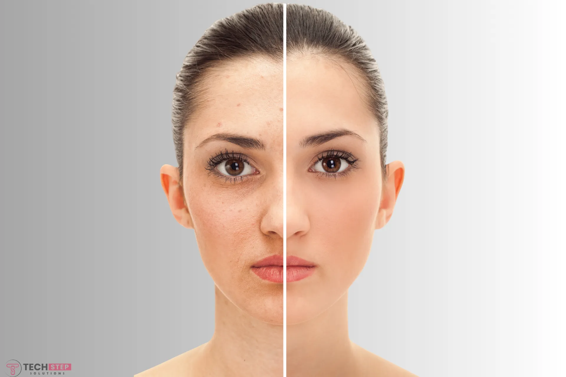 Chemical Peel Before and After: