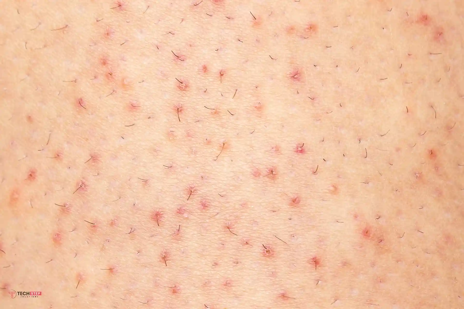 laser to remove ingrown hair