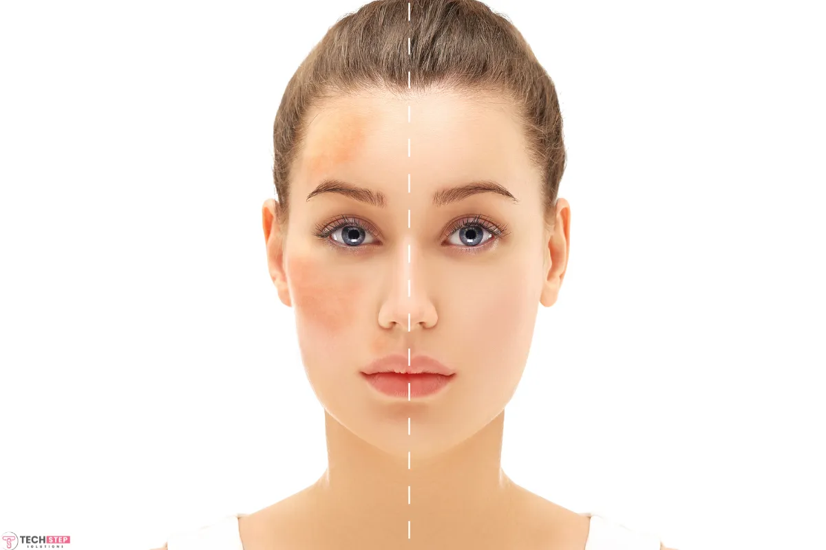 vi peel precision plus treatment in houston tx