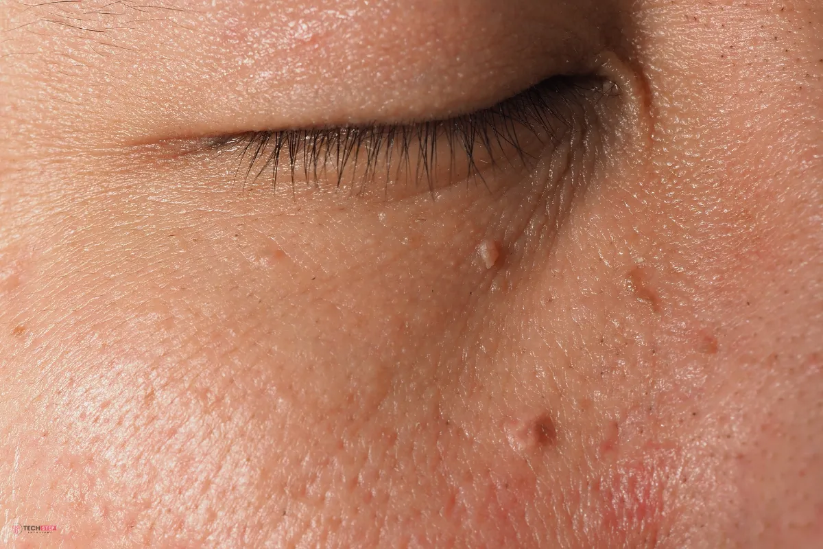 Benefits of skin tag removal