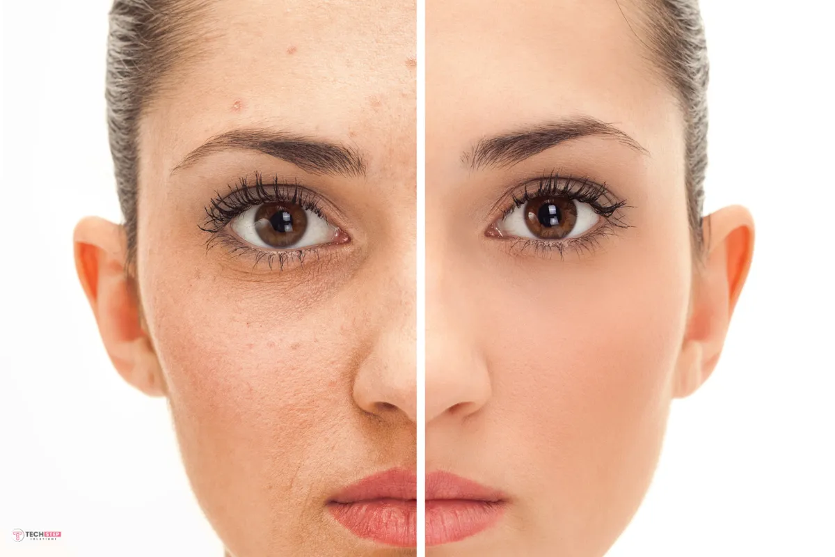 Chemical Peel Results
