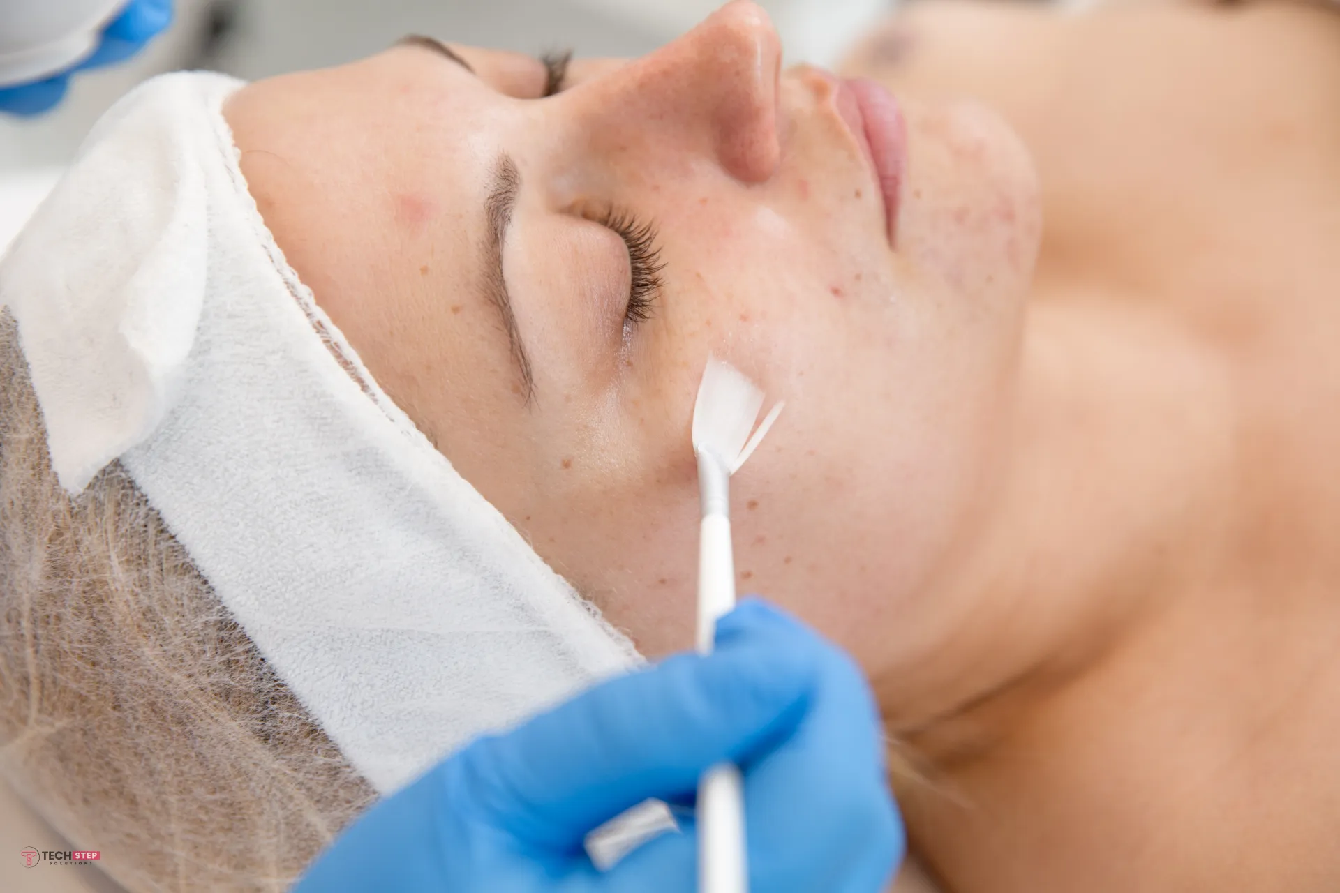 Chemical Peels Houston TX