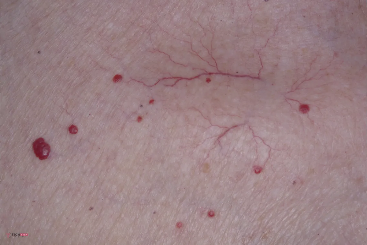 Cherry angioma skin results