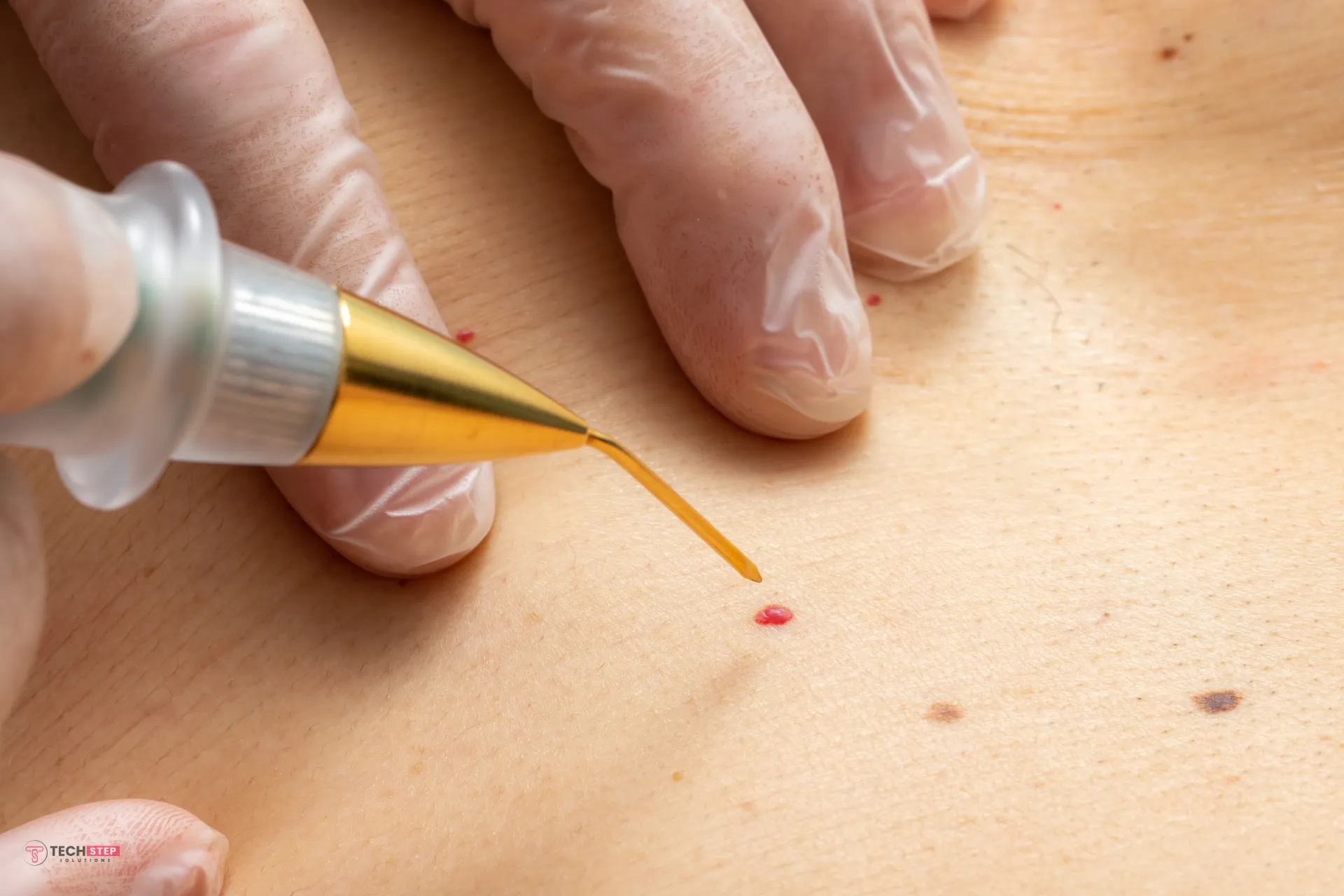 Cherry angioma skin treatment