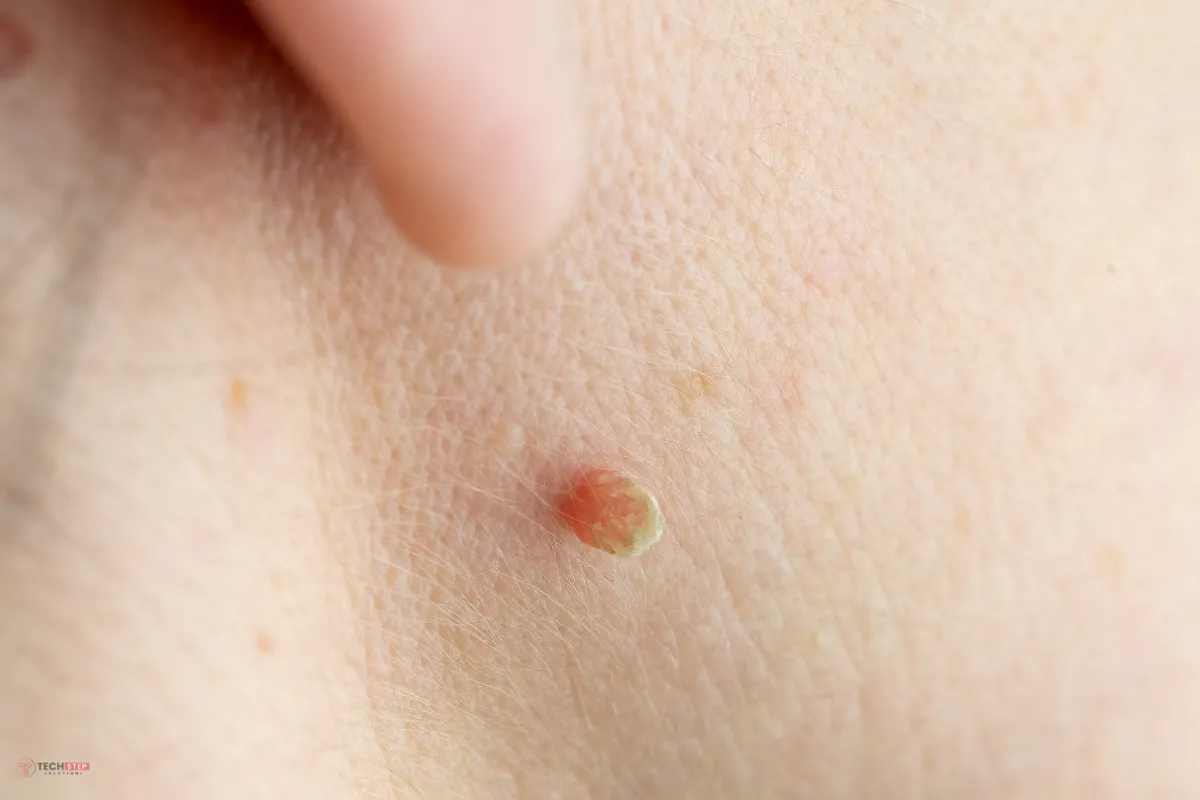 Face Skin Tag Removal