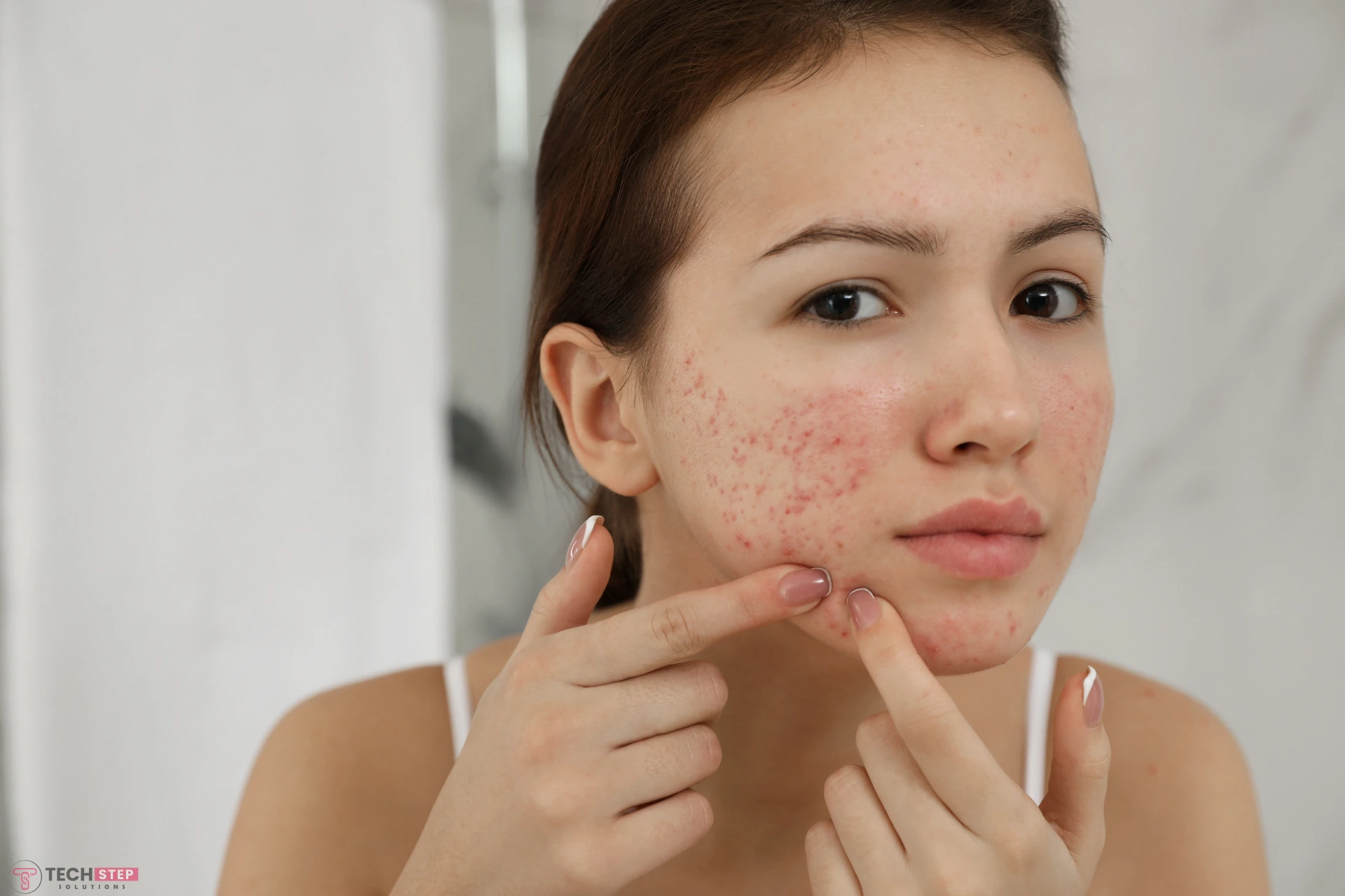 How to Get Rid of Redness From Acne