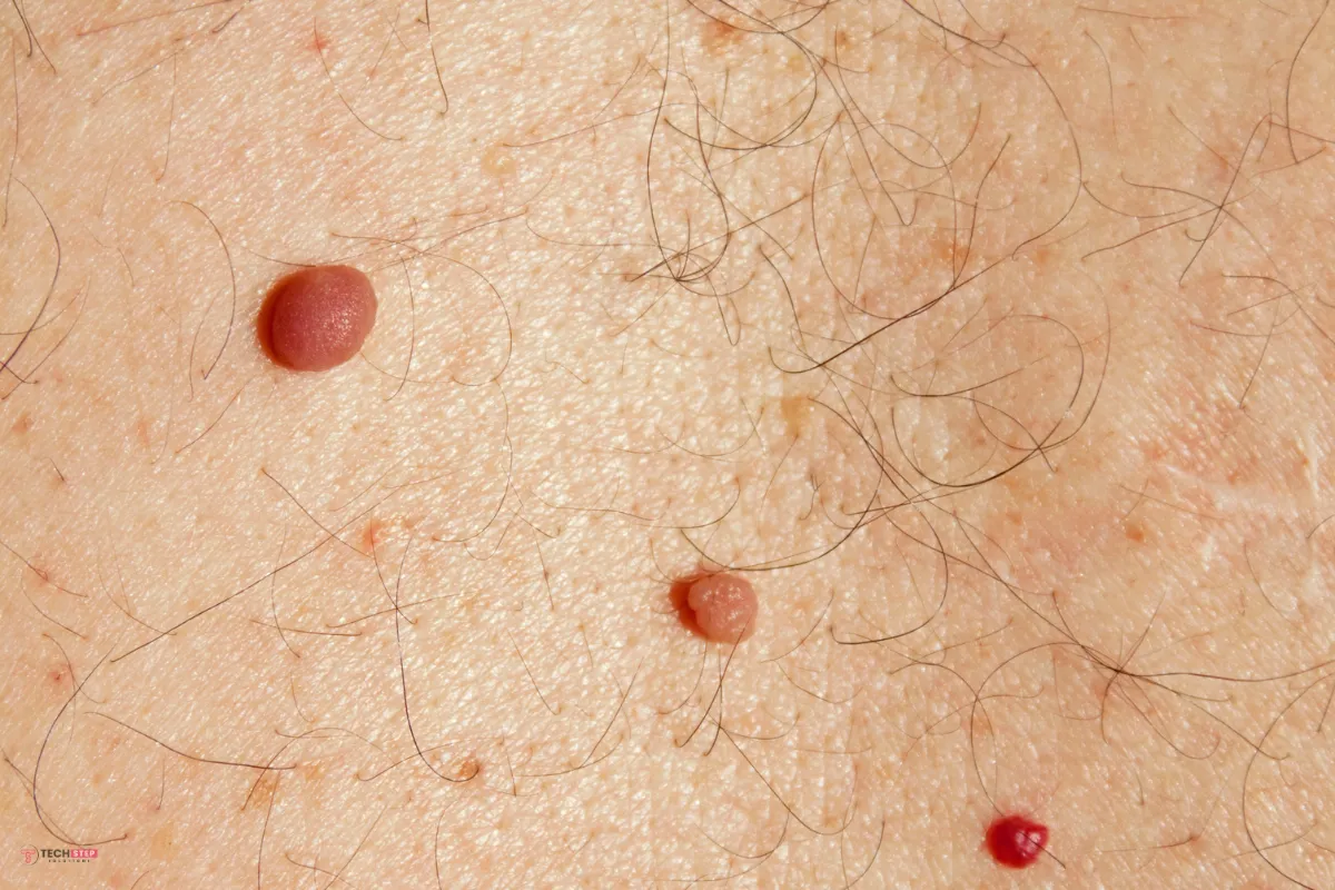 Laser treatment for cherry angioma