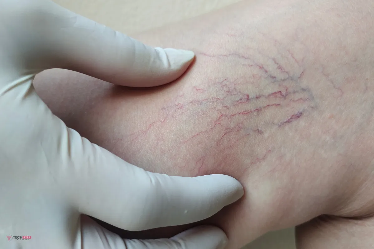 Laser treatment for spider veins