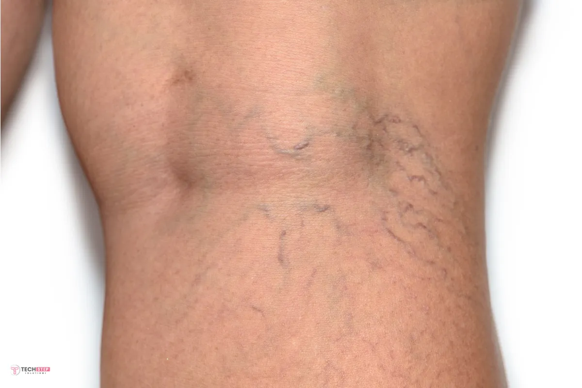 Spider Vein Treatment in Houston