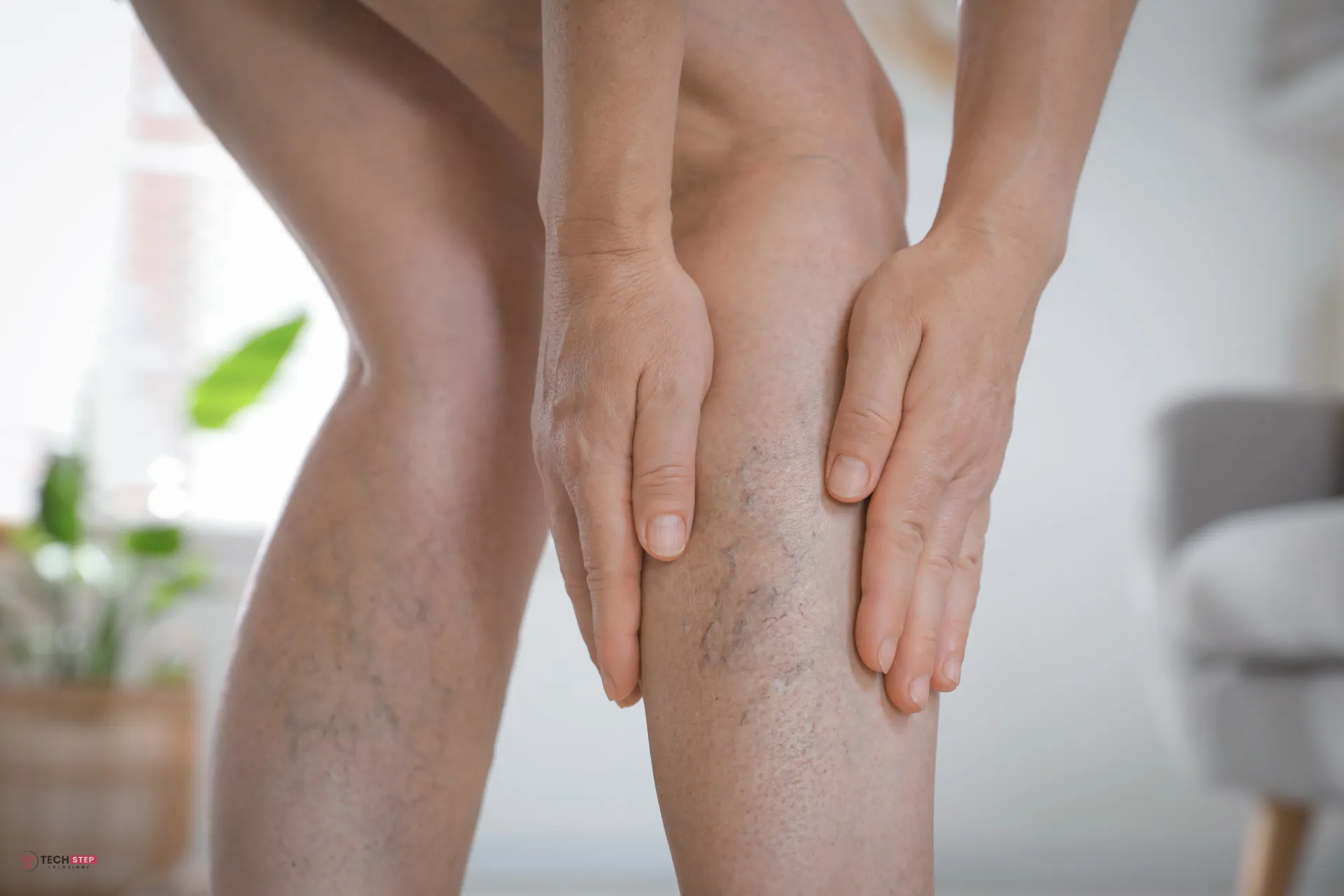 Spider vein treatment Houston