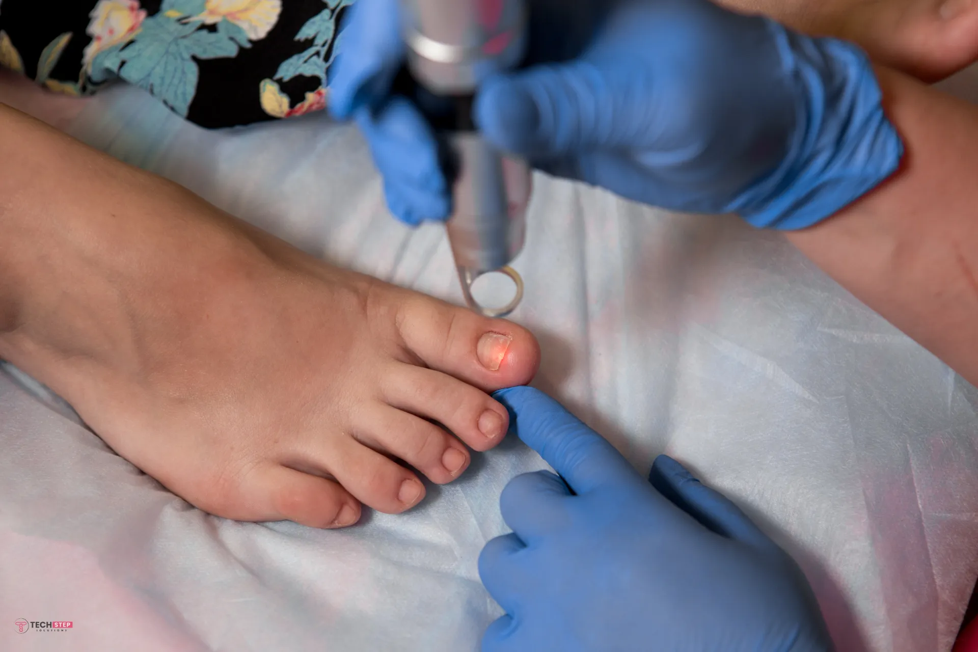 Toenail Fungus Treatment Houston