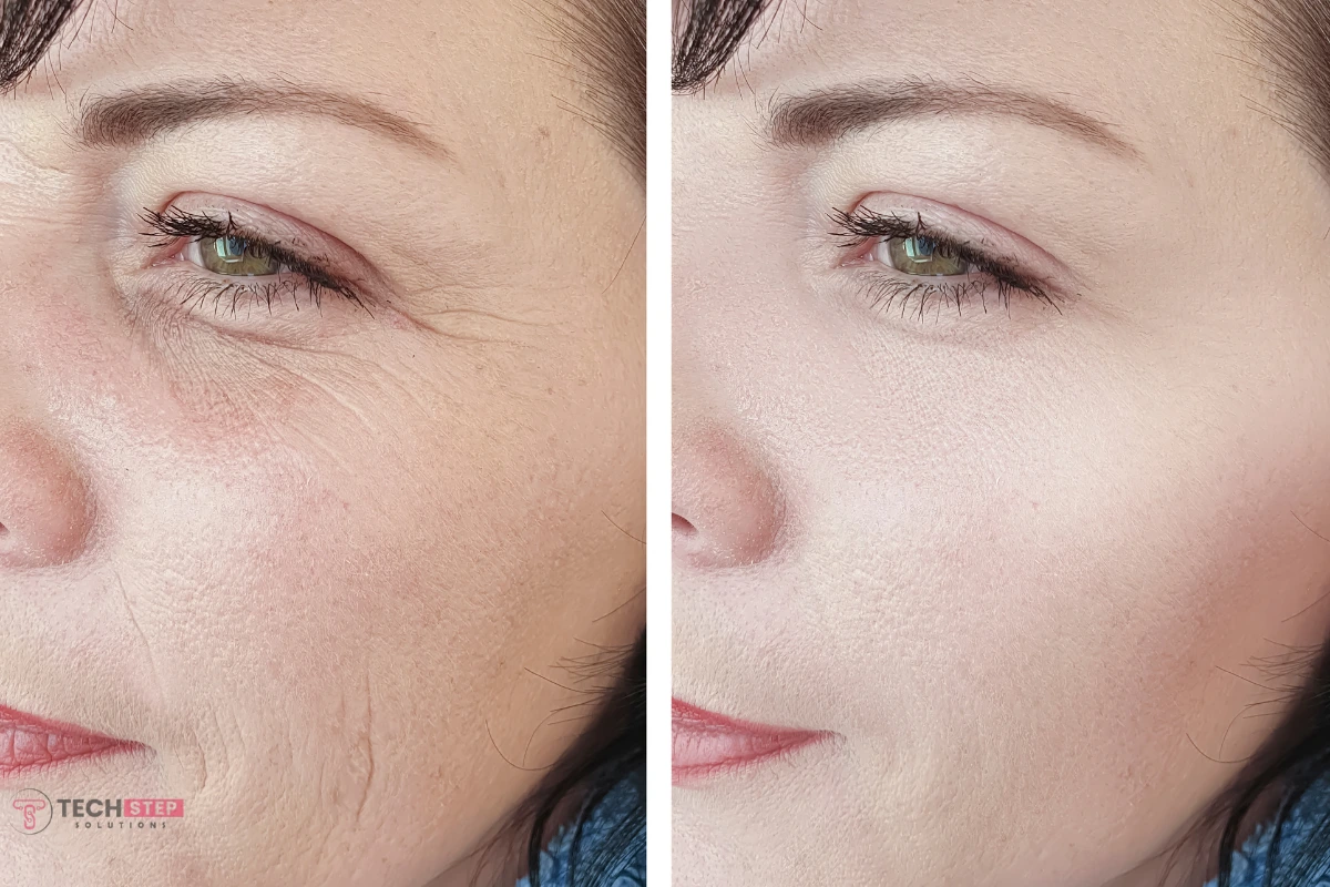 Microneedling before After