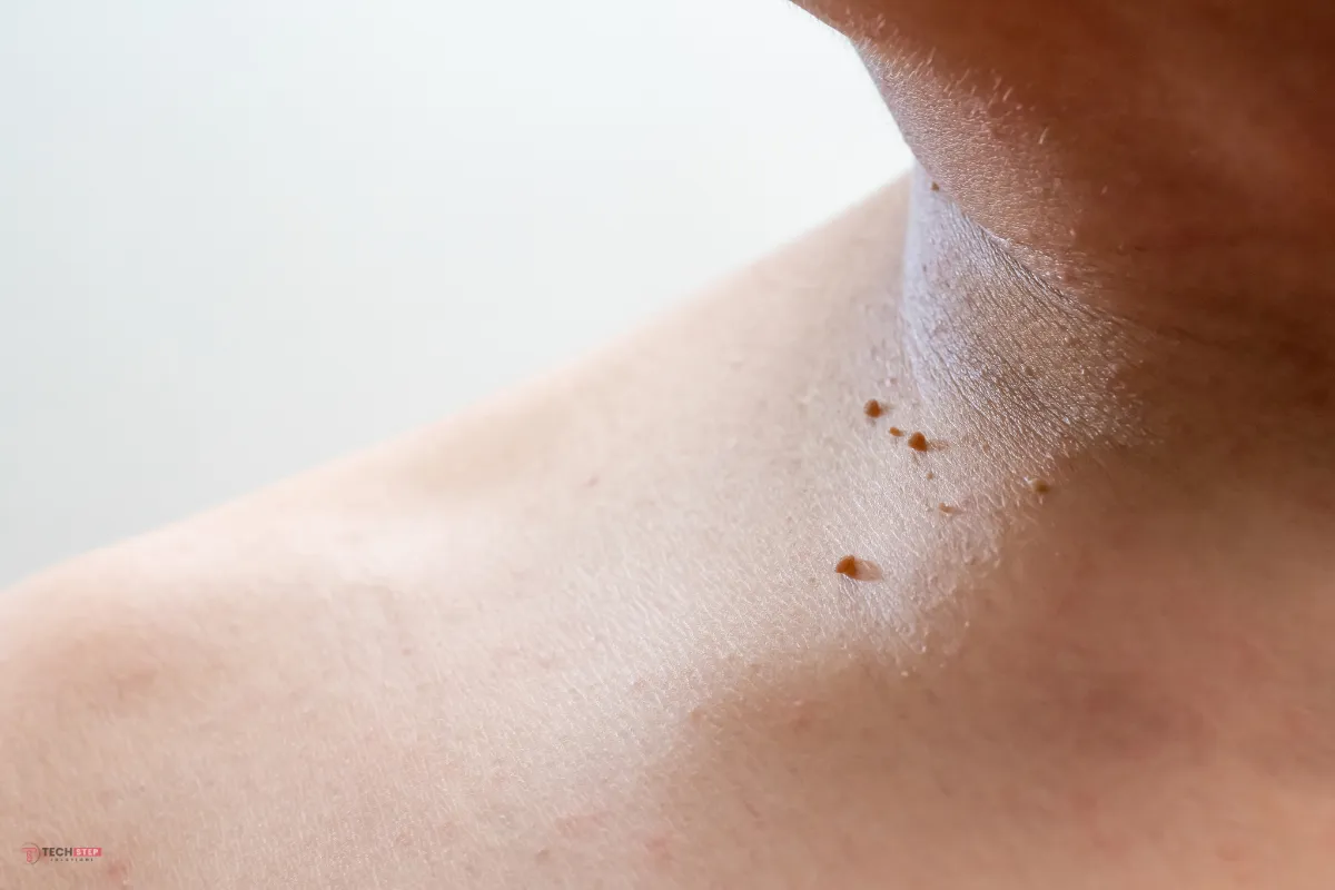 Skin Tag Removal Houston
