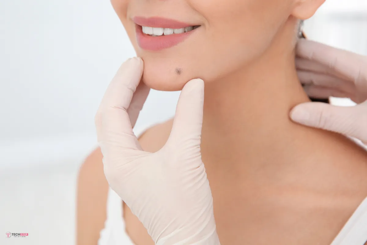wart removal before and after